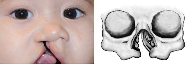 Classic deviation of caudal septum to the non-cleft side