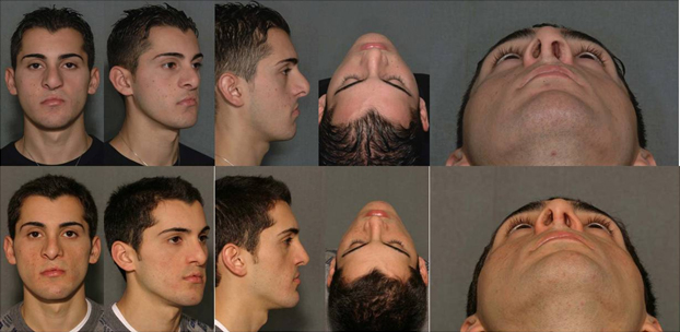 Secondary cleft rhinoplasty (preop above, postop below)