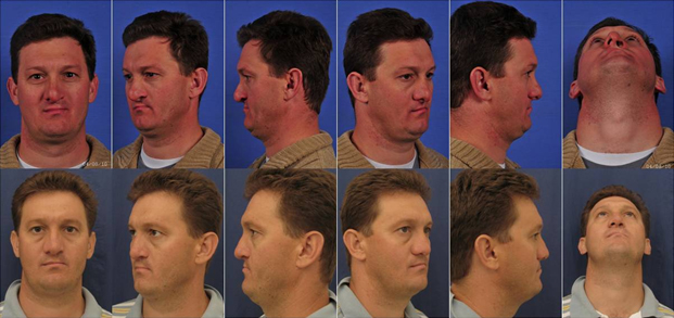 Secondary cleft rhinoplasty (preop above, postop below)