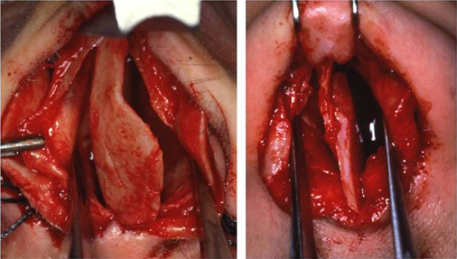 Correction of the deviated septum in the unilateral cleft lip patient