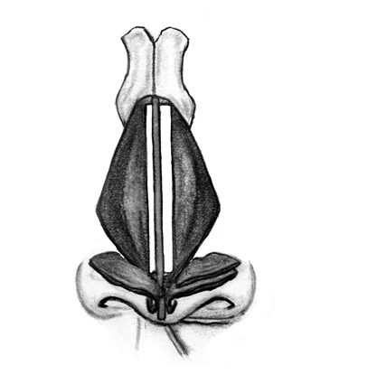 Placement of asymmetric spreader grafts