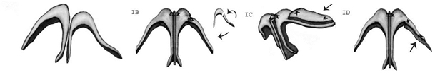 Use of resection, repositioning, and grafting techniques to correct the asymmetric lower lateral cartilages