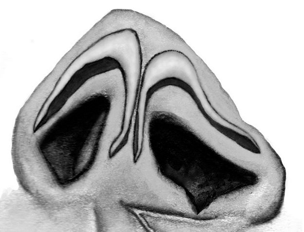 Illustration of lower lateral cartilage and alar base asymmetry.