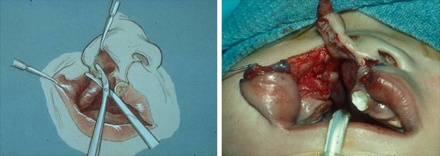 Alotomy being performed to reposition the alar base