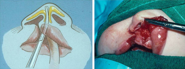 The cleft side medial crura is dissected from its cutaneous attachments