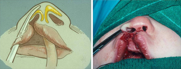 The cleft side lateral crura is dissected from its cutaneous attachments