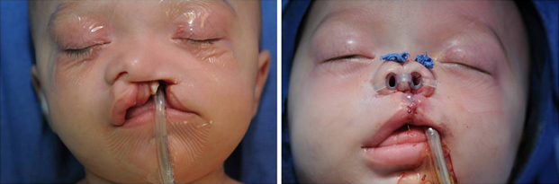 Pre and post primary cleft rhinoplasty