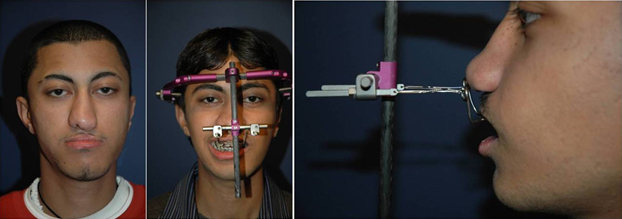 Patient with unilateral cleft lip and maxillary hypoplasia. LeFort I osteotomy with distraction osteogenesis being performed prior to secondary cleft rhinoplasty