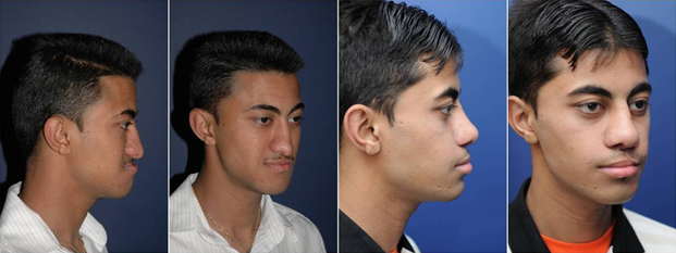 Before and after LeFort I osteotomy with distraction osteogenesis and subsequent secondary cleft rhinoplasty with autologous costal cartilage