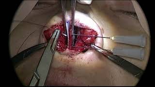 Caudal Septal Extension Graft