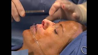 Endonasal Rhinoplasty Pt.3