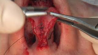 Lobule scoring & single dome suture