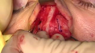 Medial Crural Resection Part 1