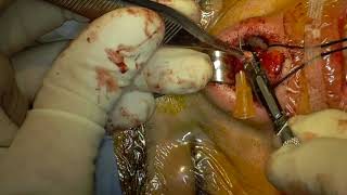 Rhinoplasty in small bulbous Asian nose