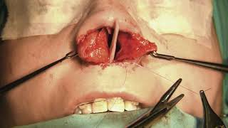 Septal Caudal Replacement Graft