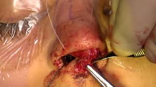 Suture Tip Deprojection