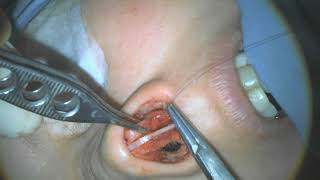 Tip Definition and Interdormal Tip Expanding Graft