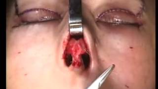 Tip Rhinoplasty Sutures