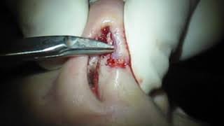 Transcolumellar Incision