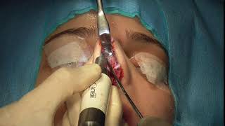 Ultrasonic Rhinoplasty Osteotomies and Dorsal Refinement Rasping (Part 2)