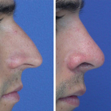 Spanish Nose Shape