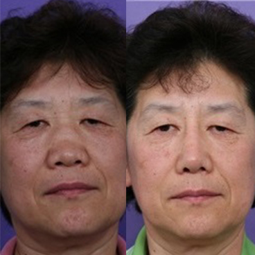 Asian Rhinoplasty - Rhinoplasty Archive