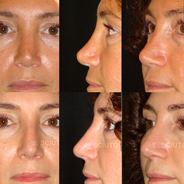 Saddle Nose - Rhinoplasty Archive