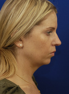 A patient with a retrusive chin point has an overall effect on the nasal profile.