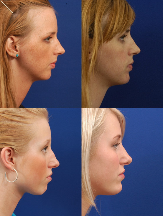 Chin augmentation surgery, before and after.