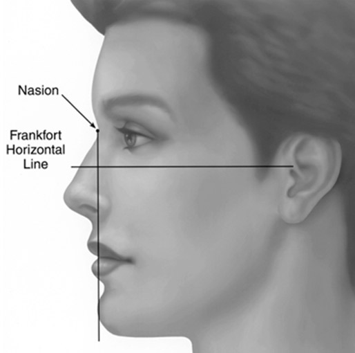 Ideal chin-nose relationship according to Gonzallez-Ulloa. The chin point aligns with a line dropped perpendicular to the Frankfort Horizontal Plane.