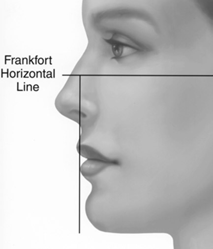 A line through the menton and perpendicular to the Frankfort horizontal plane in females lies 2-3 mm anterior to the chin, and in males approximates the chin. (Used with permission from Peter A Hilger, MD)