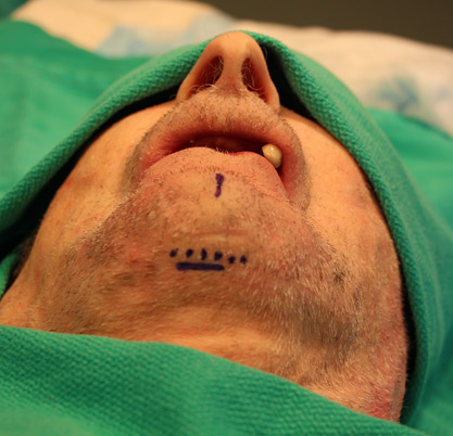 Submental (extraoral) incision placement.
