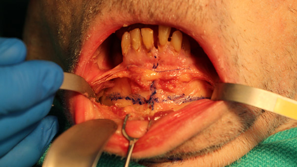 Mandibular Horizontal Sliding Genioplasty