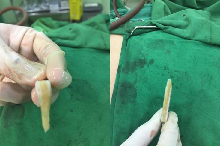 Figure 1. Central core cartilage graft (Courtesy of Dewo Aksoro Affandi)