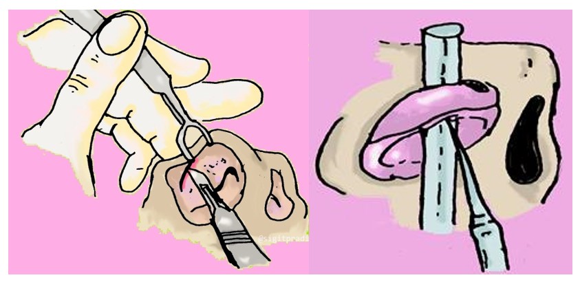 Figure 10. Marginal incision (a) Luxation technique (b)