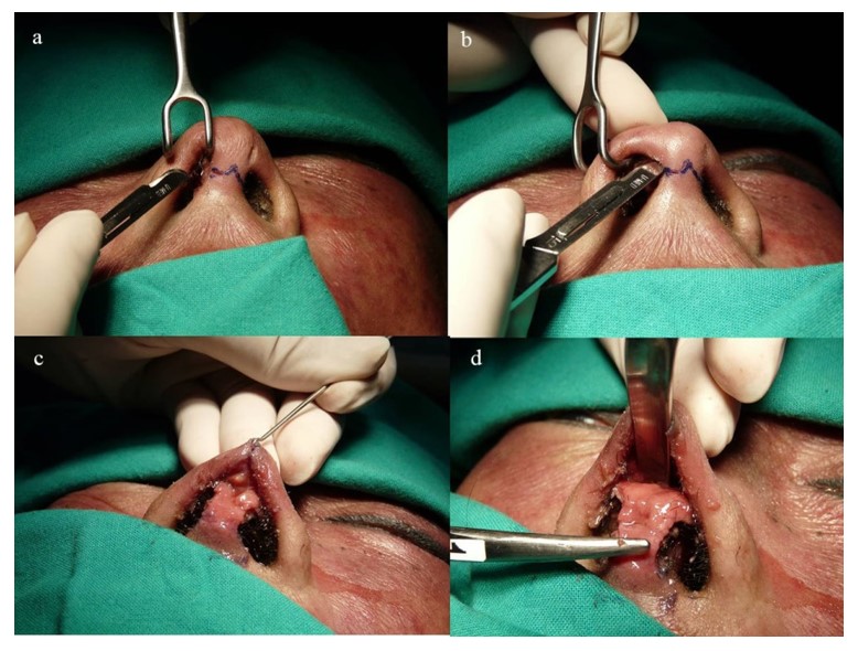 Figure 11. Transverse inverted V incision and marginal incision (a) Lateral incision to lateral alae crus cartilage (b) Flap elevation untuk dorsum nasi (c) Flap elevation to exposed nasofrontal angled (d)