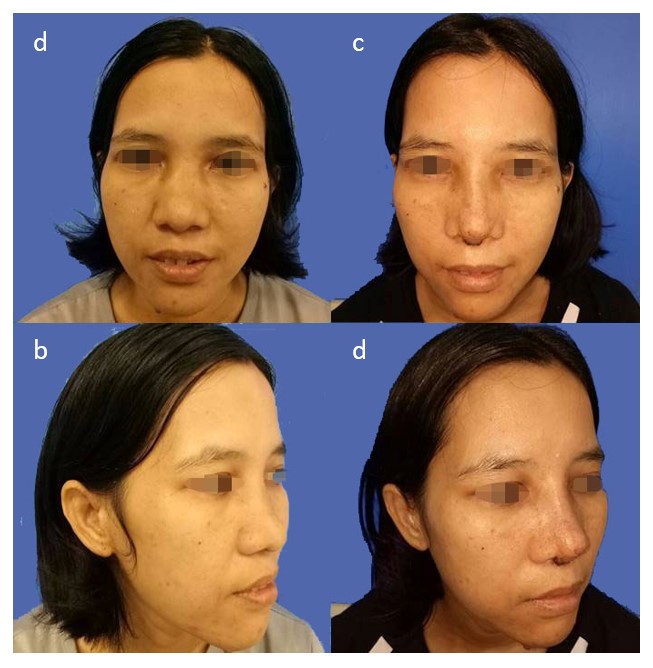 Figure 12. Before surgery showed saddle nose and severe deviated septum (a,b) and after surgery showed much better nasal dorsal browtip aesthetic line and improved tip defining point (c,d)