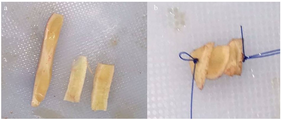 Figure 14. Spreader and dorsal augmentation graft (a) Multilayer tip graft (b)