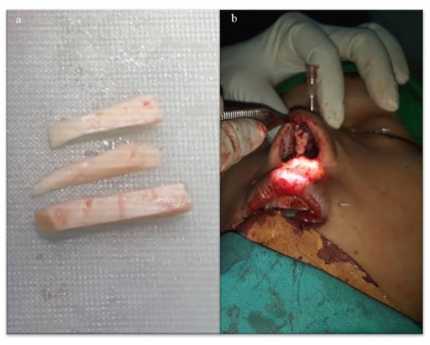 Figure 16. Material from rib graft for dorsal, spreader and shield graft (a) Intraoperative showed open septorhinoplasty spreader, dorsal augmentation and cover with shield graft (b)