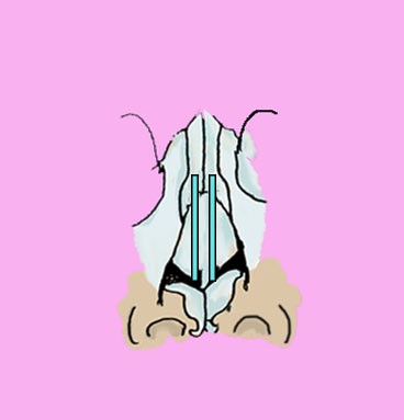 Figure 2. Spreader graft between upper lateral and septal cartilage.