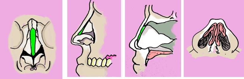 Figure 3. Dorsal augmentation graft