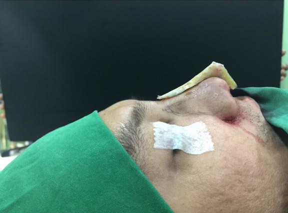 Figure 4. L-shaped dorsal graft