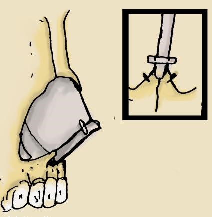 Figure 5. Septal extension graft