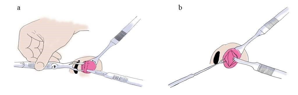 Figure 8. Left hemitransfixion incision (a) Caudal septum dissection (b)