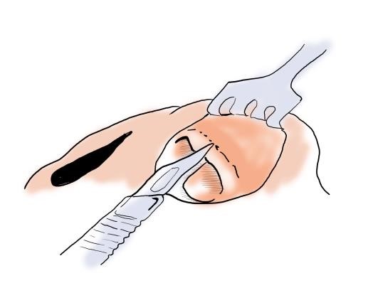 Figure 9. Intercartilaginous incision