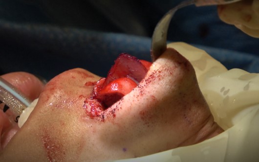 Figure 1. Intraoperative photograph of caudal septal extension graft in place