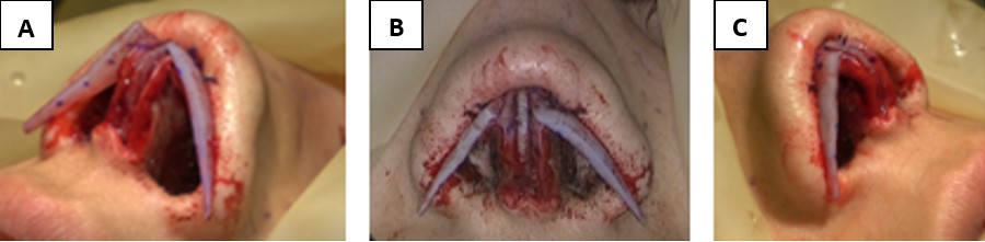 Figure 4. Intraoperative photographs showing several views of AARG placement on lower lateral cartilages prior to pocket insertion.