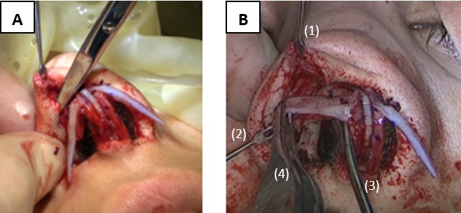 Figure 5. Intraoperative photographs showing (A) AARG pocket formation; (B) Three-point tissue retraction technique for AARG graft insertion: (1) gentle soft tissue retraction, (2) forceful marginal incision retraction, (3) gentle CSEG-neodomal complex displacement, (4) AARG graft insertion.