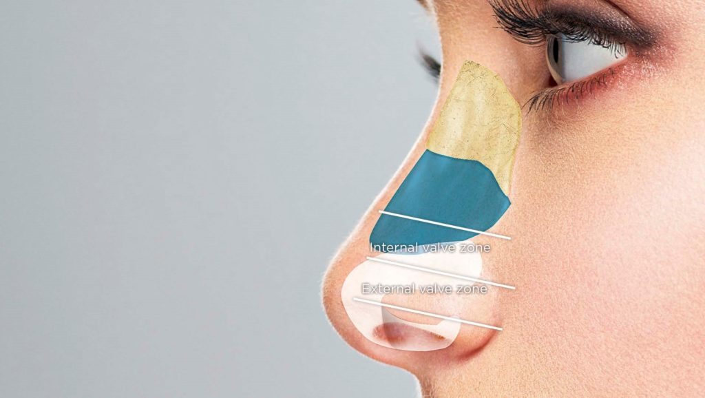 Lateral view of schematic division of internal and external nasal valve
