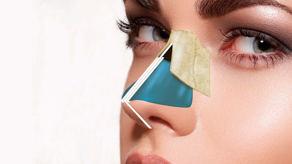 Spreader grafts. Grafts positioned between the upper lateral cartilages and the septum.